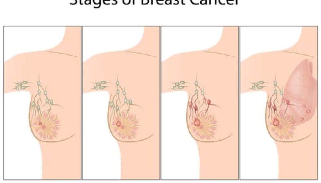 Breast_Oncosurgery